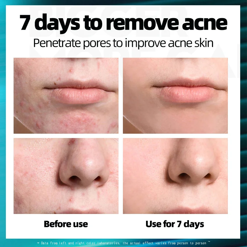MANCODES 10g Acne Treatment Face Cream Natural Plant Formulas Anti Oil Control Shrink Pores Scar Remove Care | Красота и здоровье