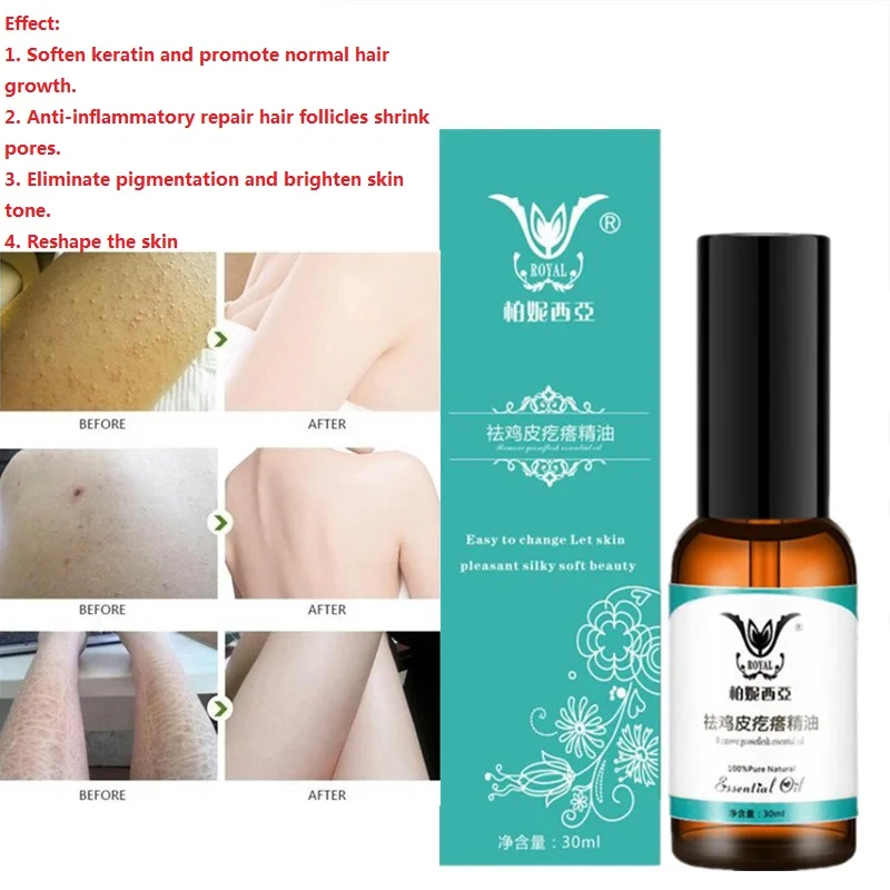 Новинка 30 мл лечение куриного фолликулита отшелушивающее сужение пор кератоз