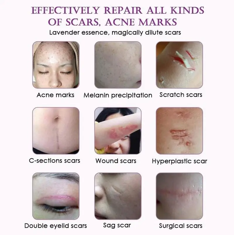 Средство для удаления шрамов 30 мл эфирное масло восстановления лаванды эссенция