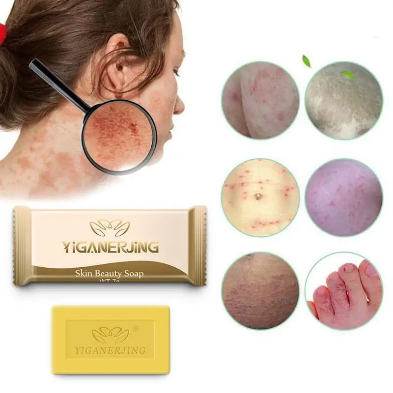 Mini 7 г/шт. серное мыло для лечения состояния кожи от акне псориаза Seborrhea Eczema