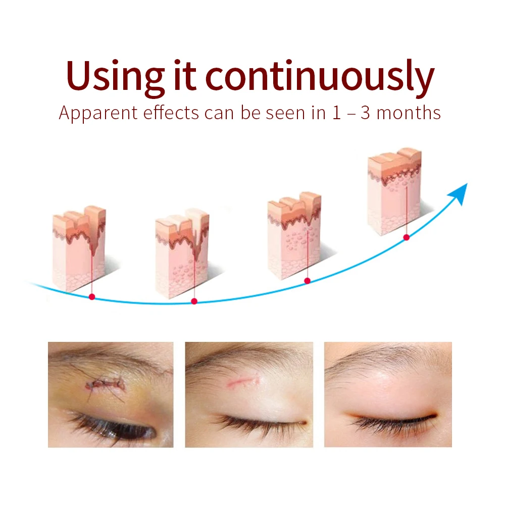Средство для удаления шрамов от акне LANBENA восстановление растяжек гель средство