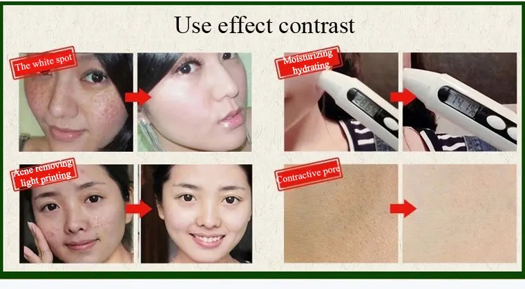 

Snail Cream acne facial cream face creamTreatment Moisturizing Anti Winkles Aging Cream skin whitening Face Skin Care