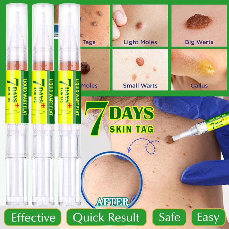 

Средство для удаления бородавок на коже против родинок и гениталий, быстрое удаление бородавок на ногах, удаление бородавок, папиломатов, б...