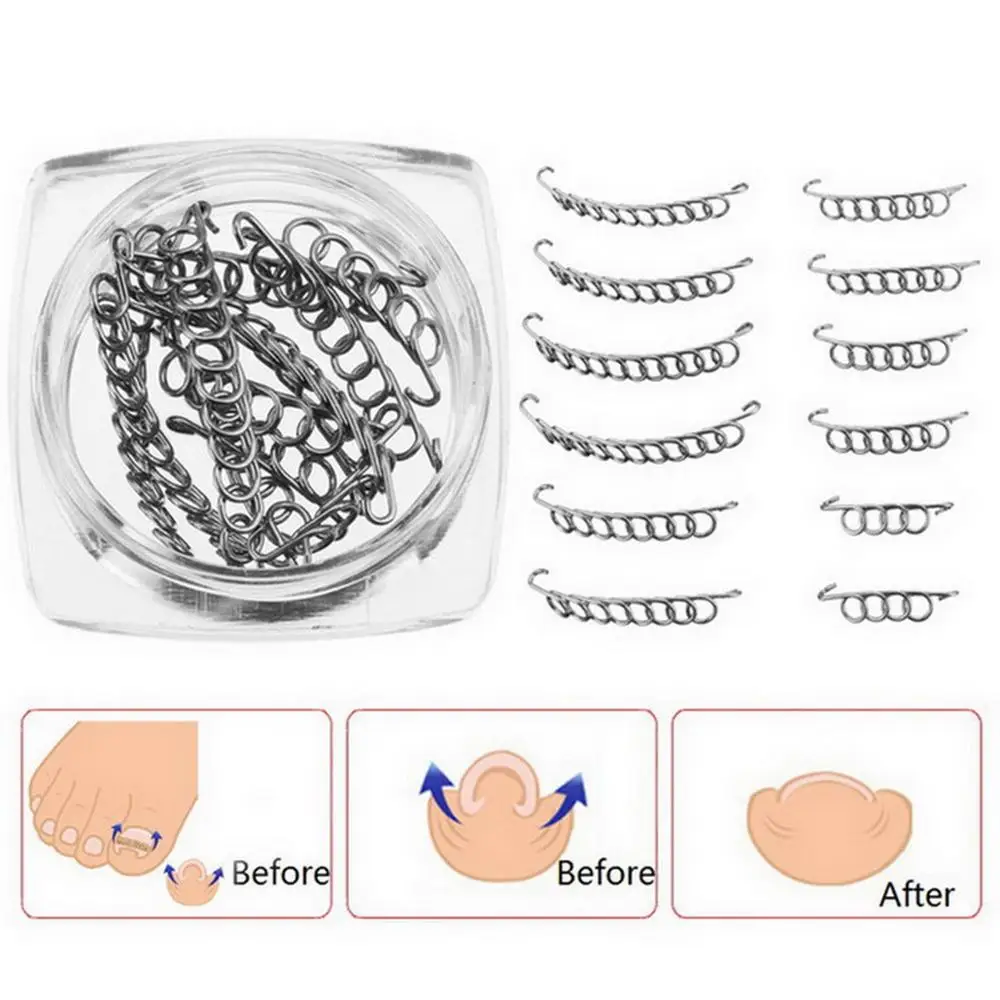 Проволока для коррекции вросших ногтей на ногах 12 шт. | Красота и здоровье