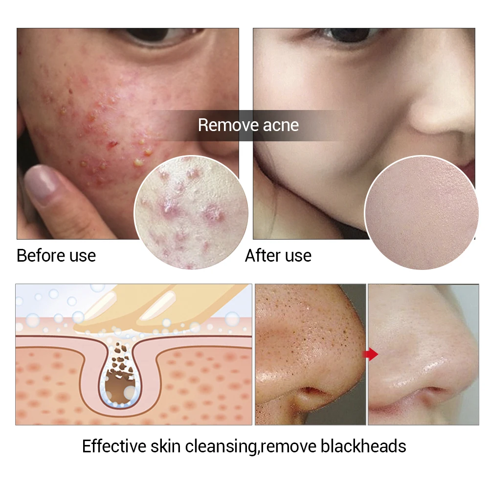 LANBENA 24K Gold Handmade Soap Tea Tree Essential Oil Facial Cleansing Acne Treatment Moisturizing Blackhead Remover Anti-Aging | Красота и