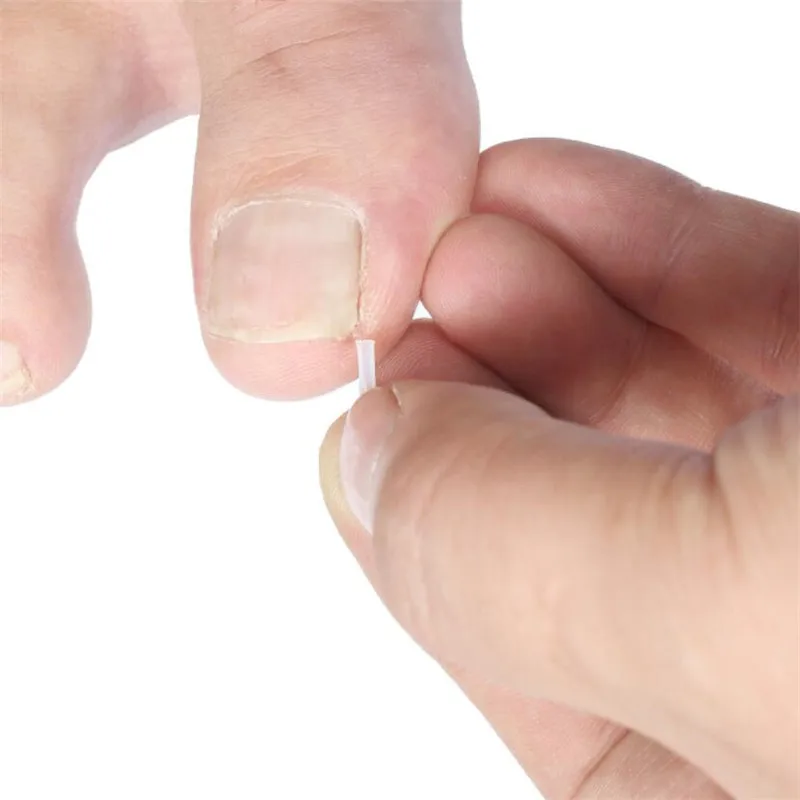 10 шт вросшие ногти тормозные колодки для ногтей паз ортопедические подушки