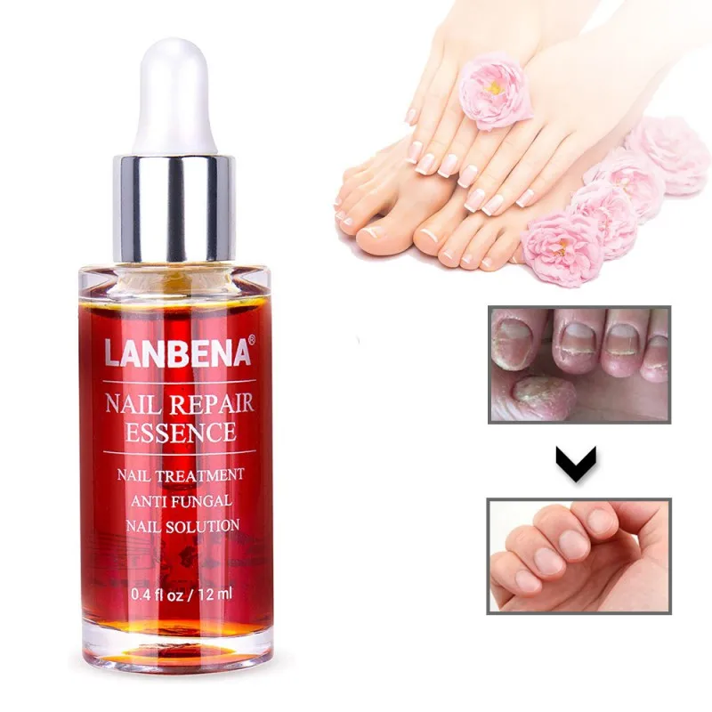 Грибковое Лечение ногтей мощное удаление грибка анти-инфекция Paronychia Onychomycosis