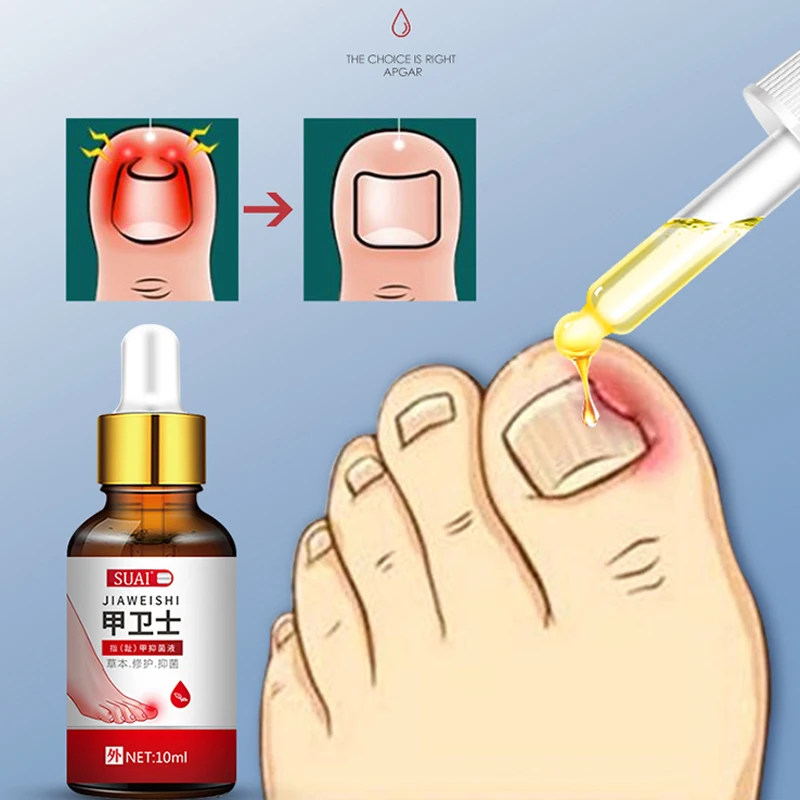 1/2 шт. сыворотка для лечения грибка ногтей | Красота и здоровье