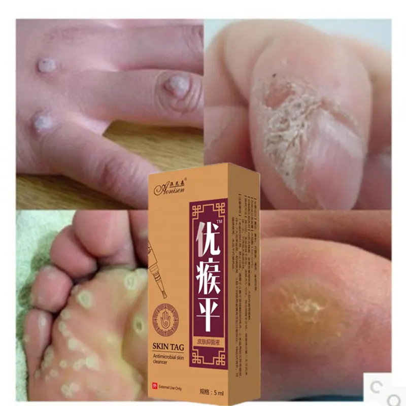 Бактериостатическое средство для удаления мозолей и генитальных бородавок на
