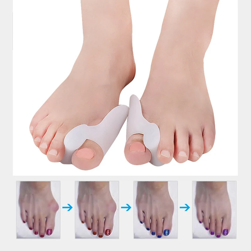 

5-30Pair Silicone Gel Bunion Big Toe Separator Spreader Foot Pain Foot Hallux Valgus Correction Guard Cushion Concealer Thumb