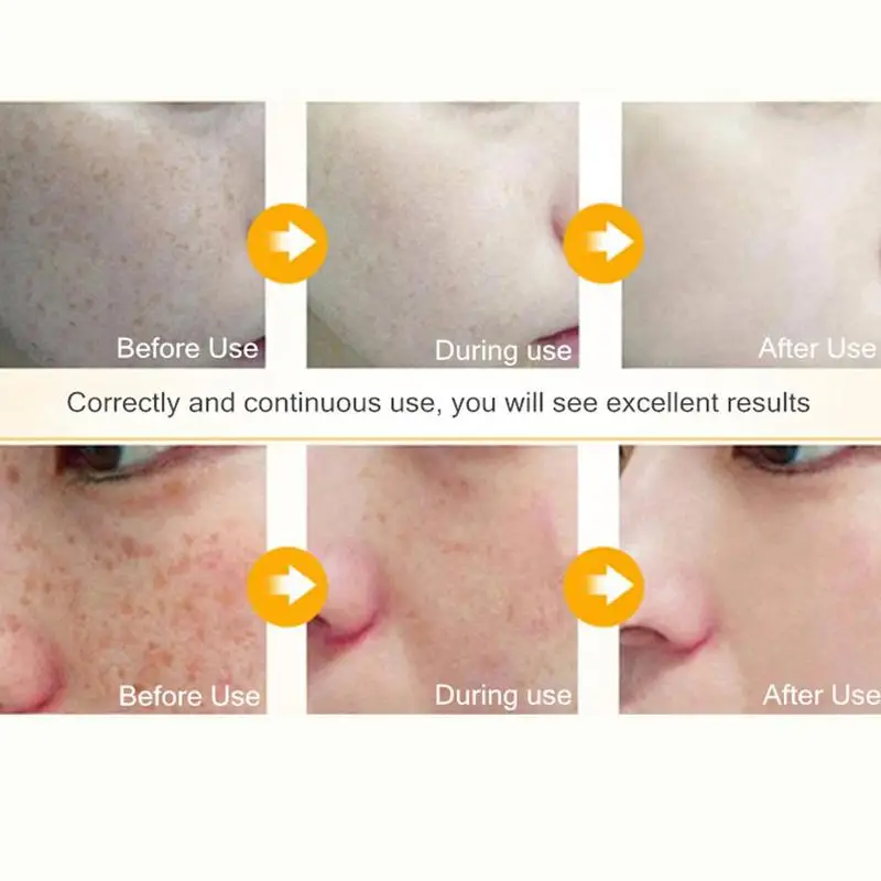 Эффективный отбеливающий крем с лимоном для удаления веснушек мелазмы пятен от