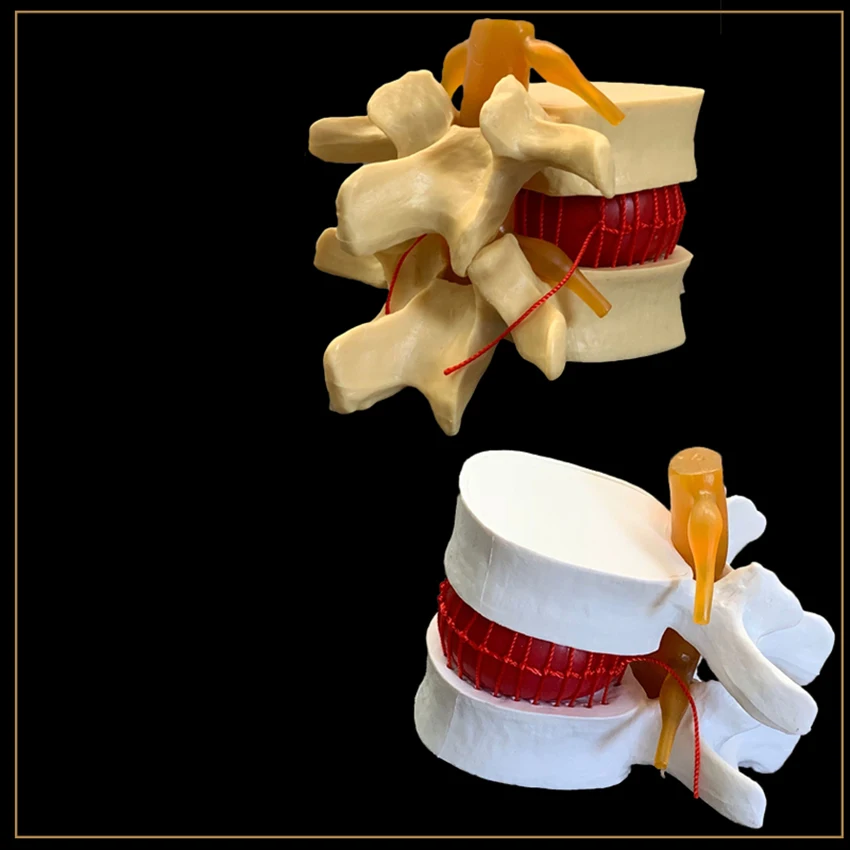 

Anatomical Human Lumbar Vertebrae Degenerative Lumbar Disc Herniation Demonstration Model Human Spine Model - White, Yellow