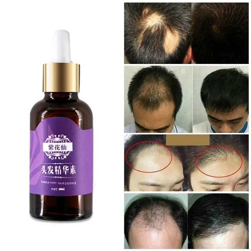 

1pc Purple Hair Growth Essential Oils Hair Care Essence Anti Hair Loss Treatment Fast Hair Growth Liquid Dense Beauty Hair Care