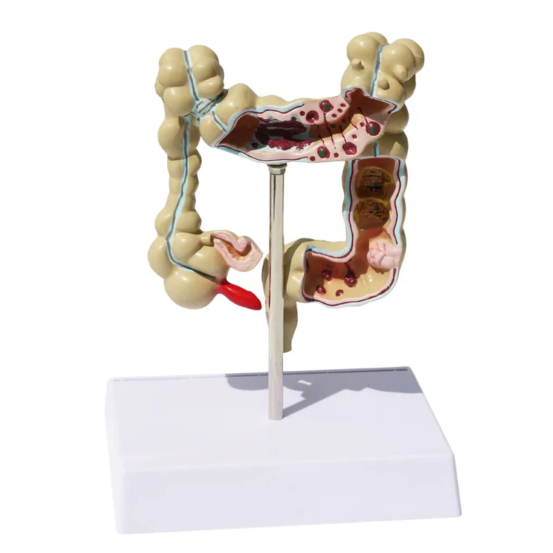 

Human Colorectal Lesion Model Pathological Anatomy Colon Diseases Intestine Medical Teaching Learning Tool