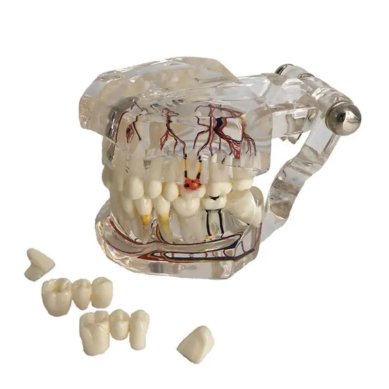 

Dental Disease Implant Teeth Model with Restoration Bridge Tooth Dentist for Medical Science Disease Teaching Study
