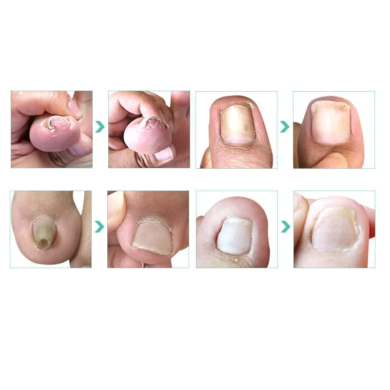 Инструмент для педикюра с вросшим ногтем профессиональное восстановление