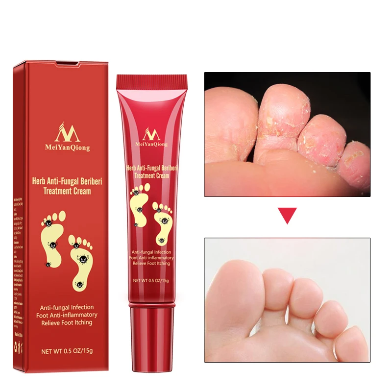 

Herbal Effective Foot Treatment Anti Fungal Infection Onychomycosis Paronychia Toe Fungus Treatment Feet Repair Cream Foot Care