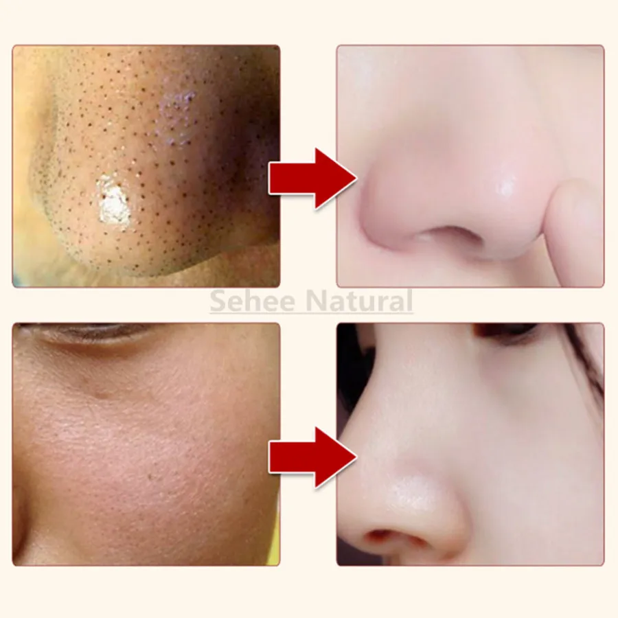 Chinese Herbal Acne Cream Acne Print Removing Whiten Freckle Day Cream 1000g 1kg Beauty Salon Equipment