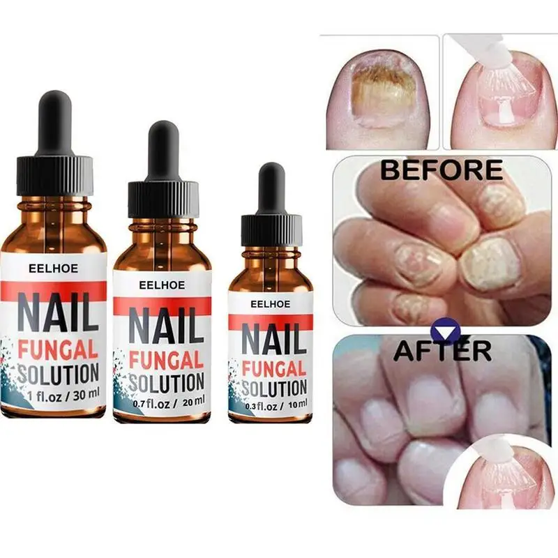 

30Ml Nail Reparatie Serum Essences Schimmel Care Behandelingen Gel Anti-Infectieuze Voet Verwijdering Nagel Schimmel Parony K8A4