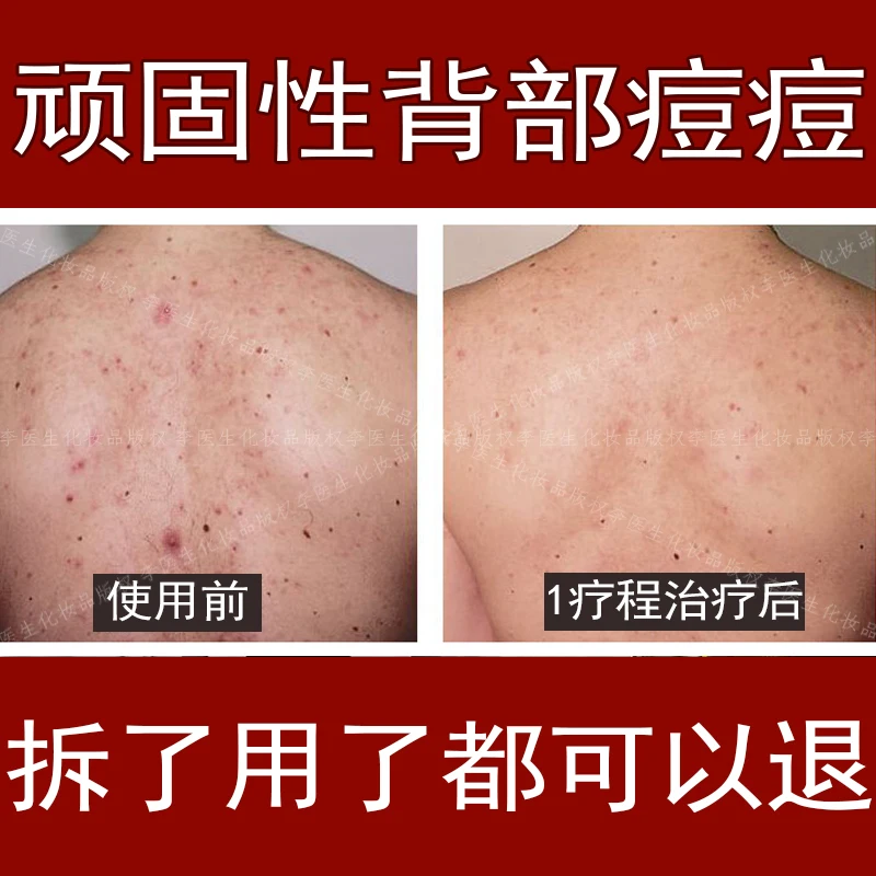 Pore Cleaner Nose Blackhead Remover Face Deep T Zone Acne Pimple Removal Vacuum Suction Facial Diamond Beauty Care SPA Tool Skin | Красота и