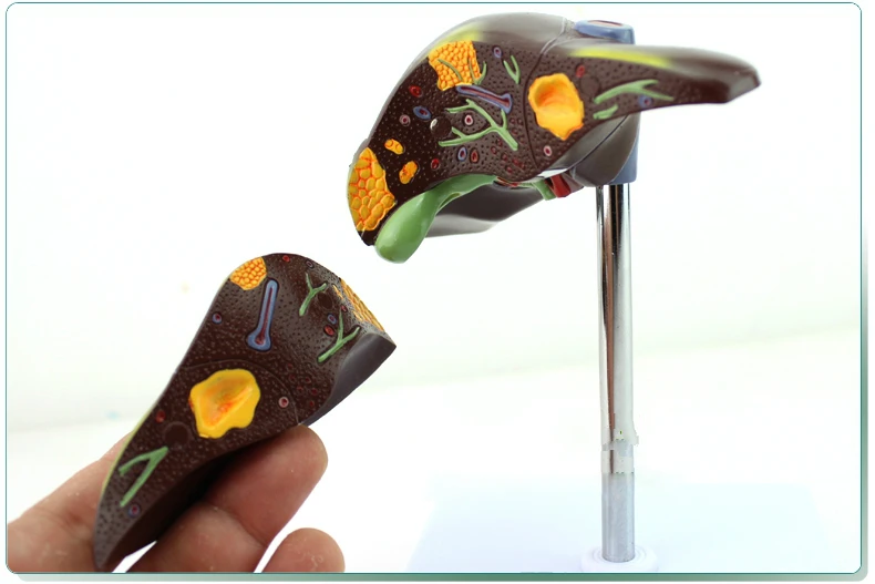 Гепатит В жировая печень цирроз печени модель пищеварительная медицина