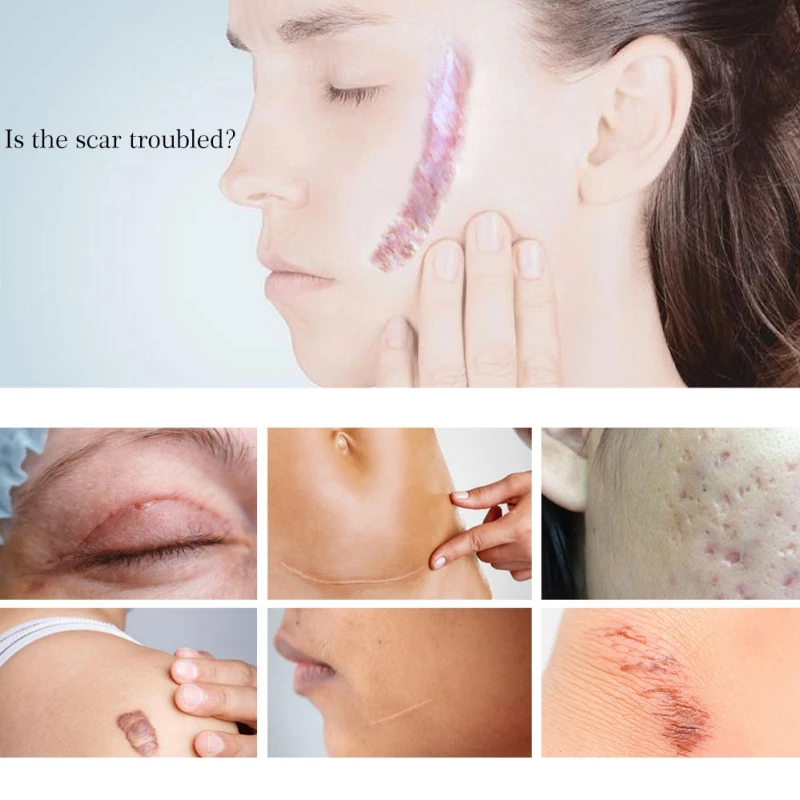 Крем Для Удаления растяжек после акне уход за кожей восстанавливающий крем для