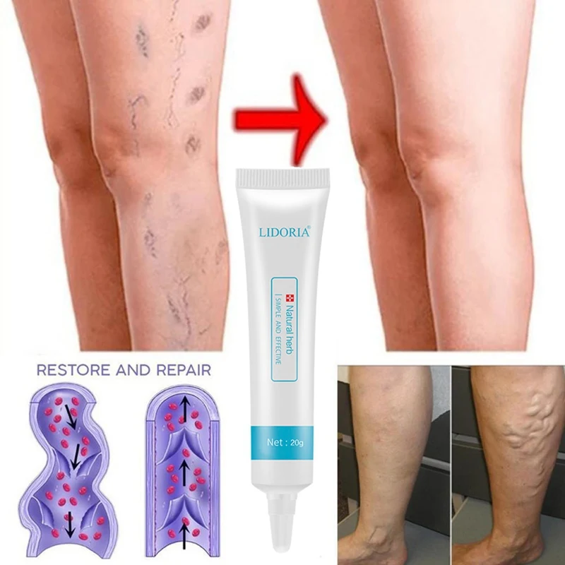 Varicose Veins Cream Promote Blood Circulation Relief Phlebitis Vasculitis Treatment Ointment Vessel Care |