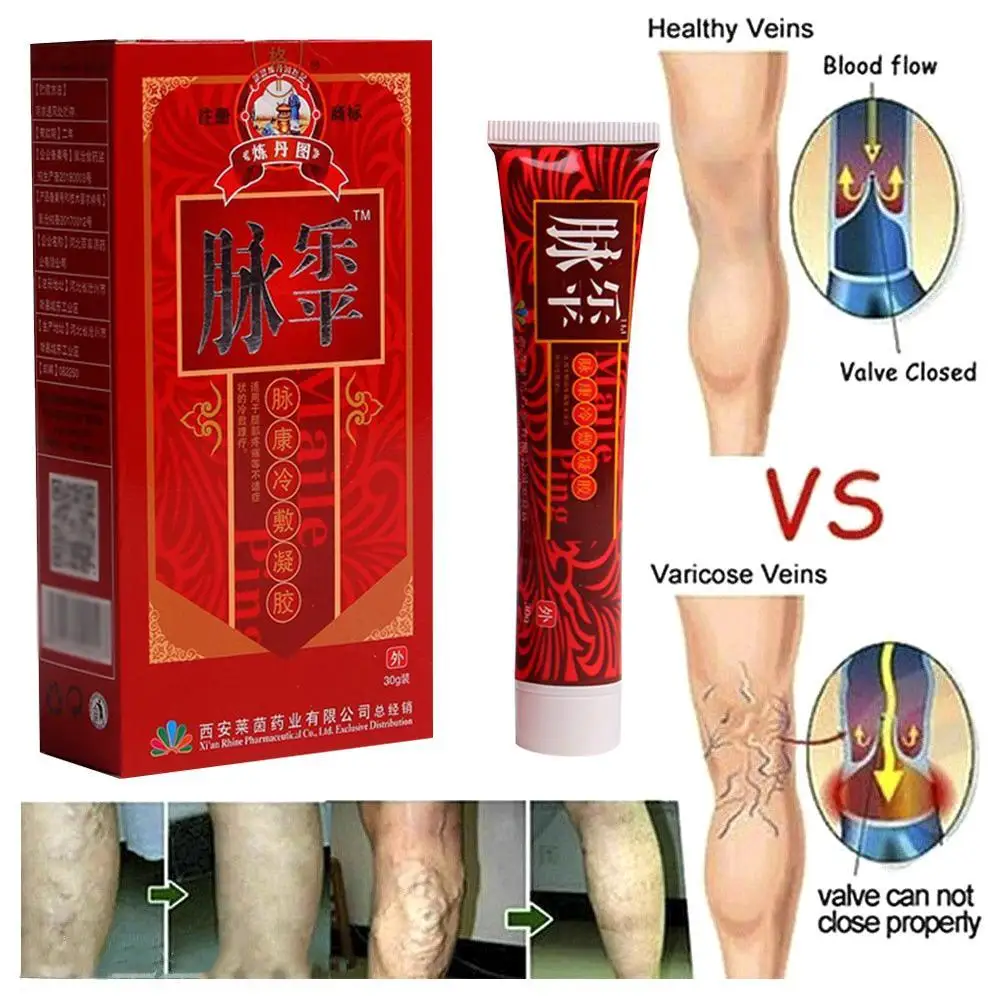 Varicose Veins Treatment Cream Effective Vasculitis Phlebitis Spider Varicosity Angiitis Ointment Herbal |