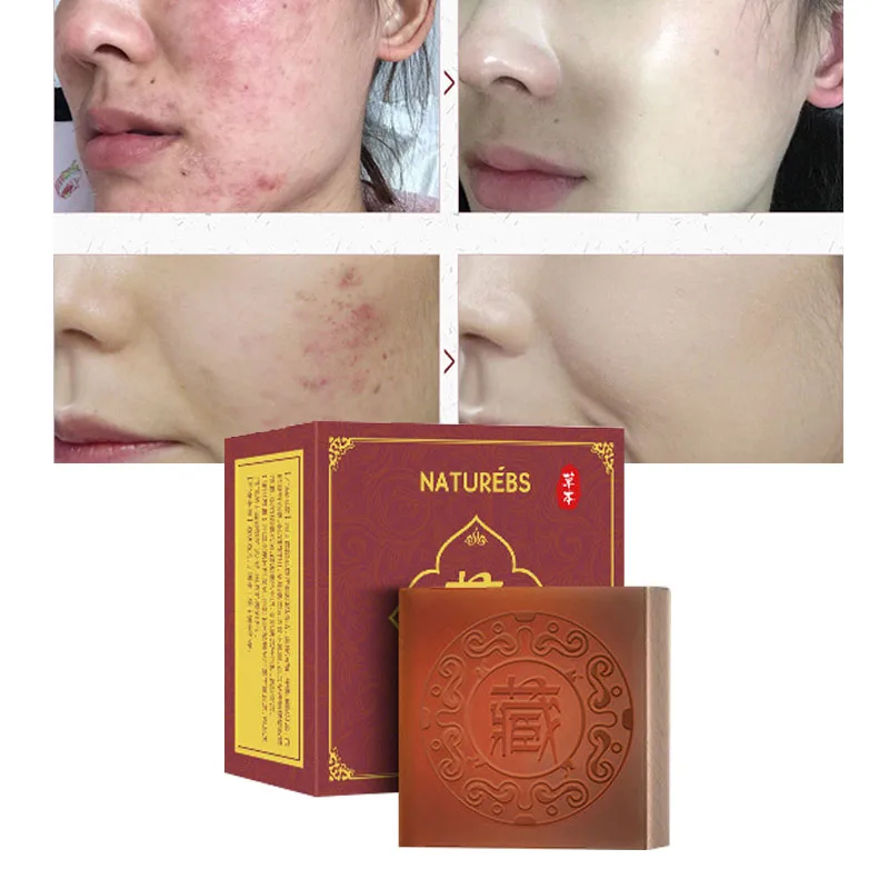 Травяной очиститель мыла ручной работы Удаление прыщей для пор и угрей лечение