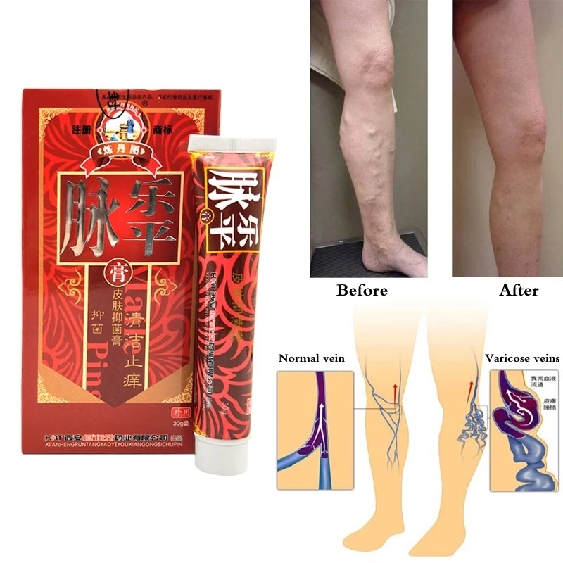 

Chinese Herbal Medicine Varicose Vein Cream Vasculitis Phlebitis Leg Spider Treatment Rotten Leg Varicose Plaster Health Care