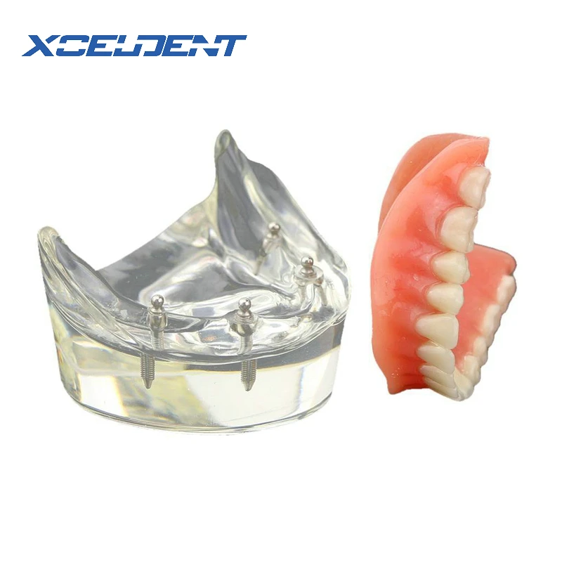 

1pcs Dental Teeth Teaching Overdenture Inferior 4 Implant Demo Model Teeth Model Mandibular with Implant Restoration Model