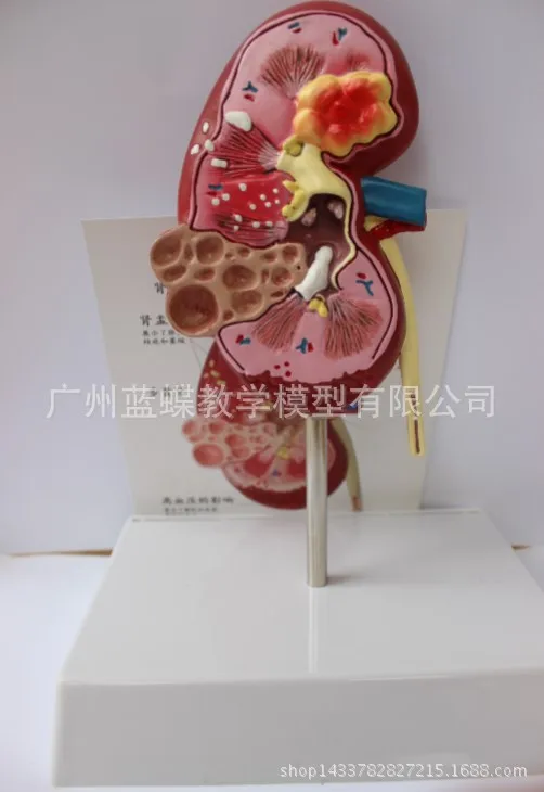 Почечные камни модель заболеваний урология Nephron Renal glomelus анатомическая почечная