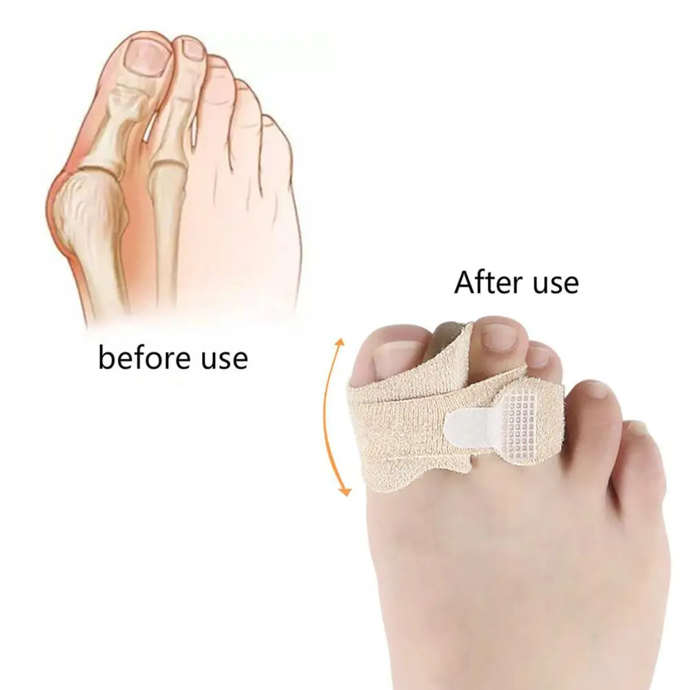 Исправление вальгусной деформации первого пальца стопы коррекционный бандаж