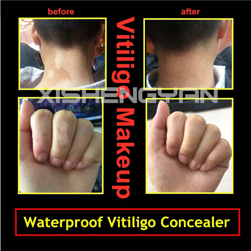 Чехол vitilgo патчи водонепроницаемый мгновенный кожи Leucoderma макияж покрытие консилер ручка на лицо руки тела для женщин мужчин детей 1 шт