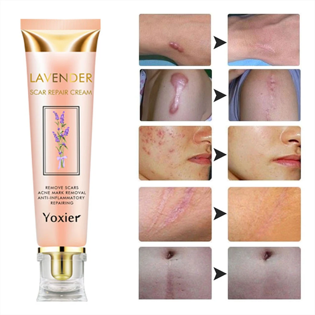 Крем для удаления шрамов растяжек следов от акне крем лечения ожогов гладкой и