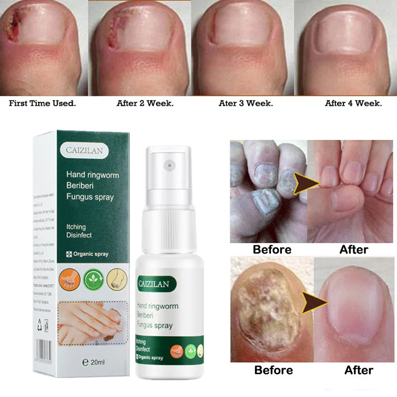 

Новый 20 мл ног анти-грибной эссенция Сыворотки удалить онихомикоз лечение жидкость здоровье и уход за ногтями ремонт жидкого раствора