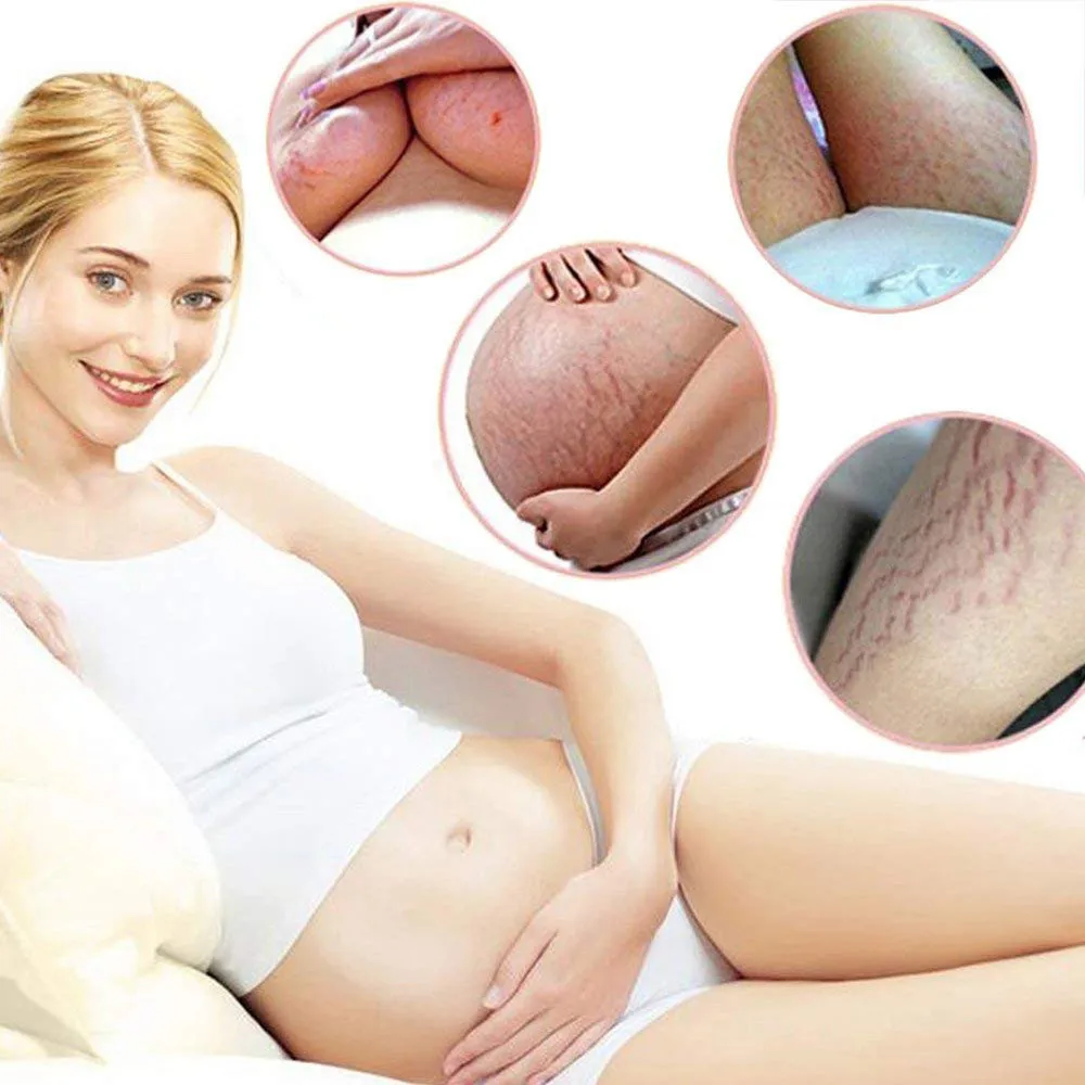 Стрии Gravidarum восстанавливающий крем для удаления рубцов от акне стрейч Знаки жира