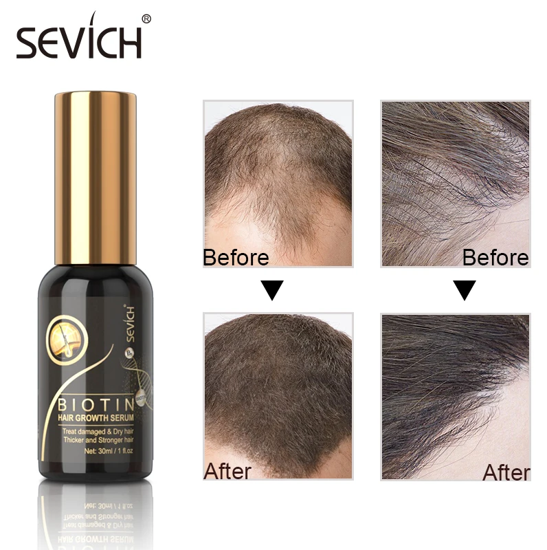 

Sevich New Hair Growth Essential Spray Biotin Hair Care Serum Fast Anti Hair Loss Treatment Moisturizing Repair Growing oil 30ml