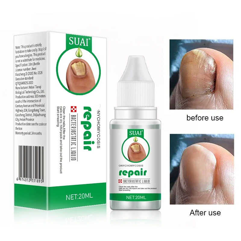 

30ML Nail Fungal Treatment Feet Care Essence Nail Foot Toe Nail Fungus Removal Gel Anti Infection Paronychia Onychomycosis