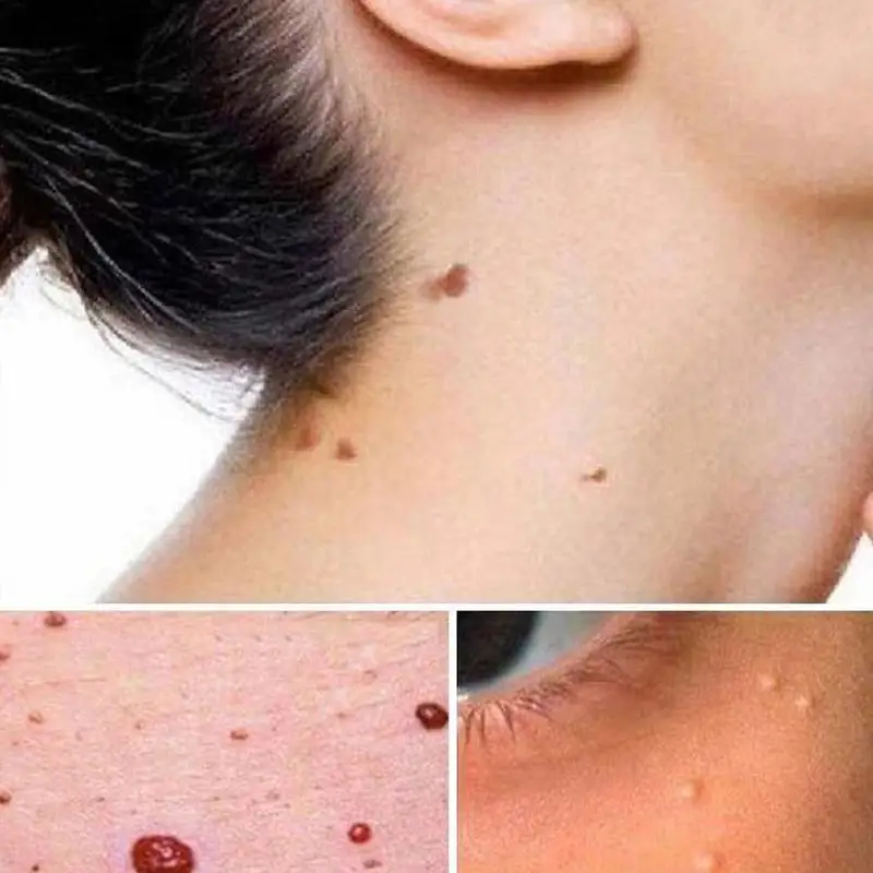 

10ml Mole removal and whitening essential oil Freckle Safe Painless Care Mole Skin Solution Fast Acid-Free Effective Remove W9W7
