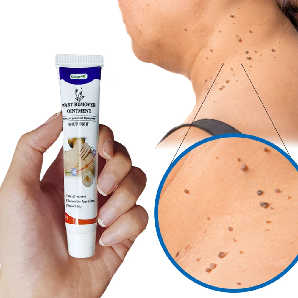

1pcs Wart Removal Ointment Wart Treatment Cream Neck Skin Tag Armpit Flat Wart Genitals Wart Feet Corns Medical Wart Cream 20g