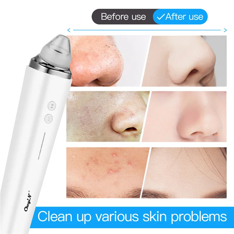 

Vacuum Blackhead Remover Nose Facial Pore Cleaner Suction Black Dot Acne Black Head Pimple Remover Phone Readable Skin Care Tool