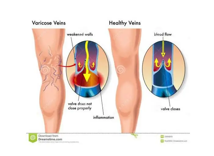 Противоутомительные Компрессионные носки отлично подходят для путешествий