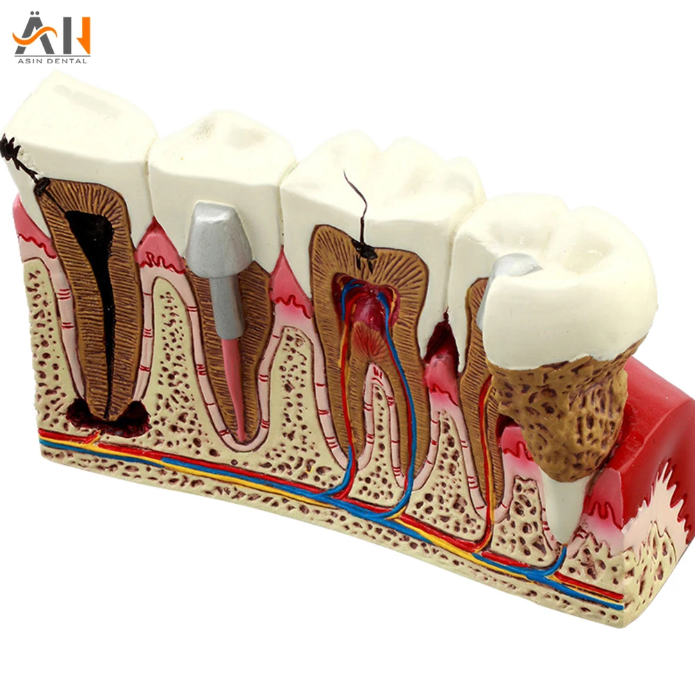 

Стоматологические материалы, стоматологическая анатомия, демонстрация стоматологических кариеса, пластиковая модель зубов