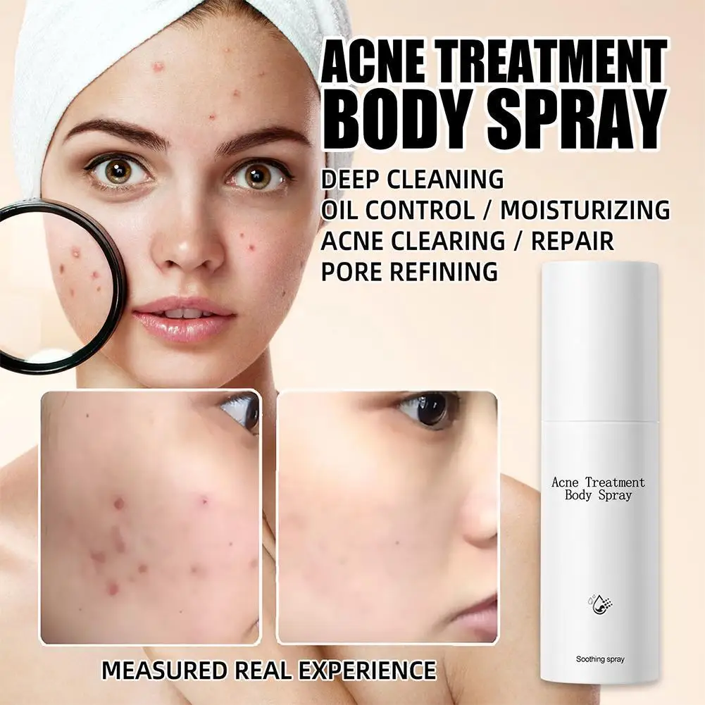 100ml New Acne Treatment Spray Moisturizing Spray Skin Face Treatment Essence Oil-control Spray Oil Acne N7f1