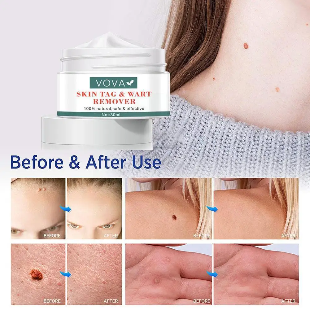 

1pcs Instant Blemish Removal Gel Acne Wart Removal Cream Warts Remover Skin 30 Wart Body G Care Cream Foot Cream Treatment W5T3