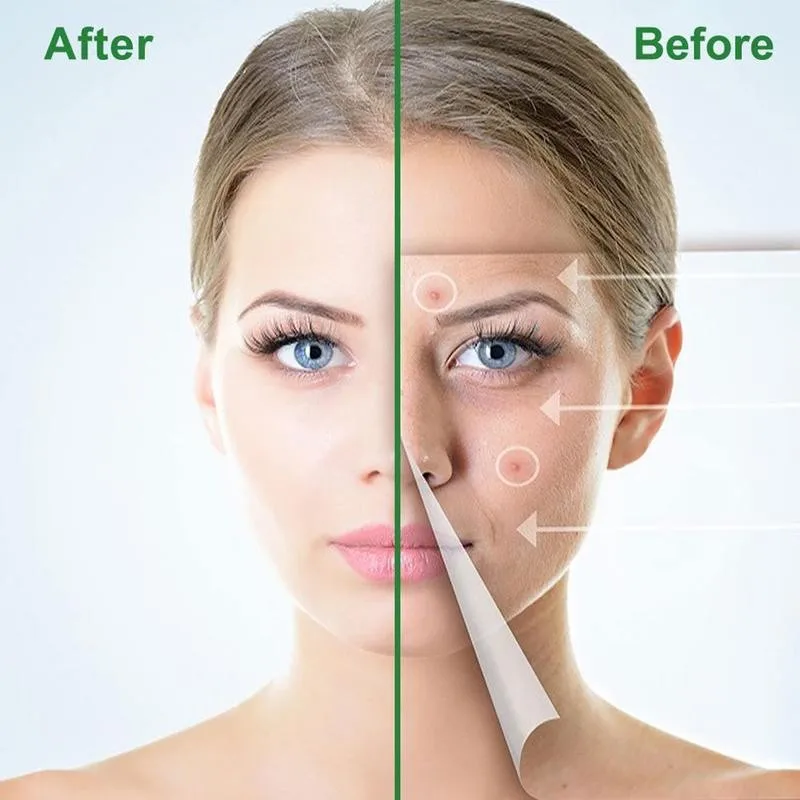 24pcs/sheet Acne Pimple Patch Effectively Treatment Face Skin Blemish Master Invisible Remover Acnes Mask Stickers Beauty Tool