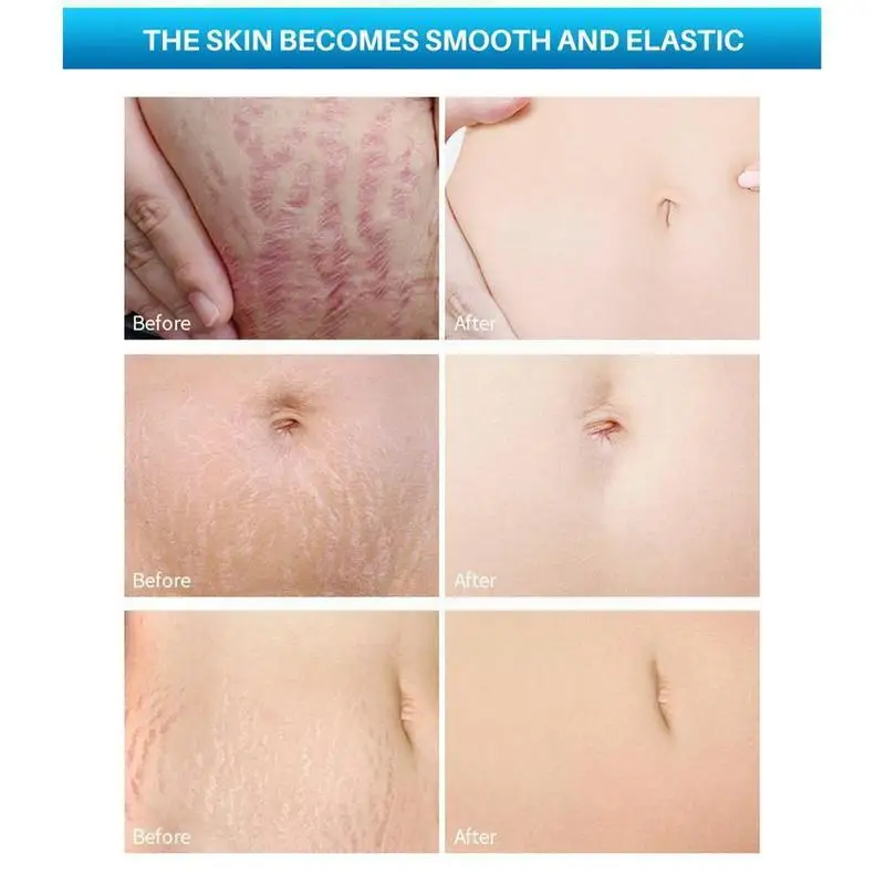 

30ml Pregnancy repair oil Remover Eliminate Pregnancy Repair Anti Treatment Winkle Maternity Scars Firming E9V9