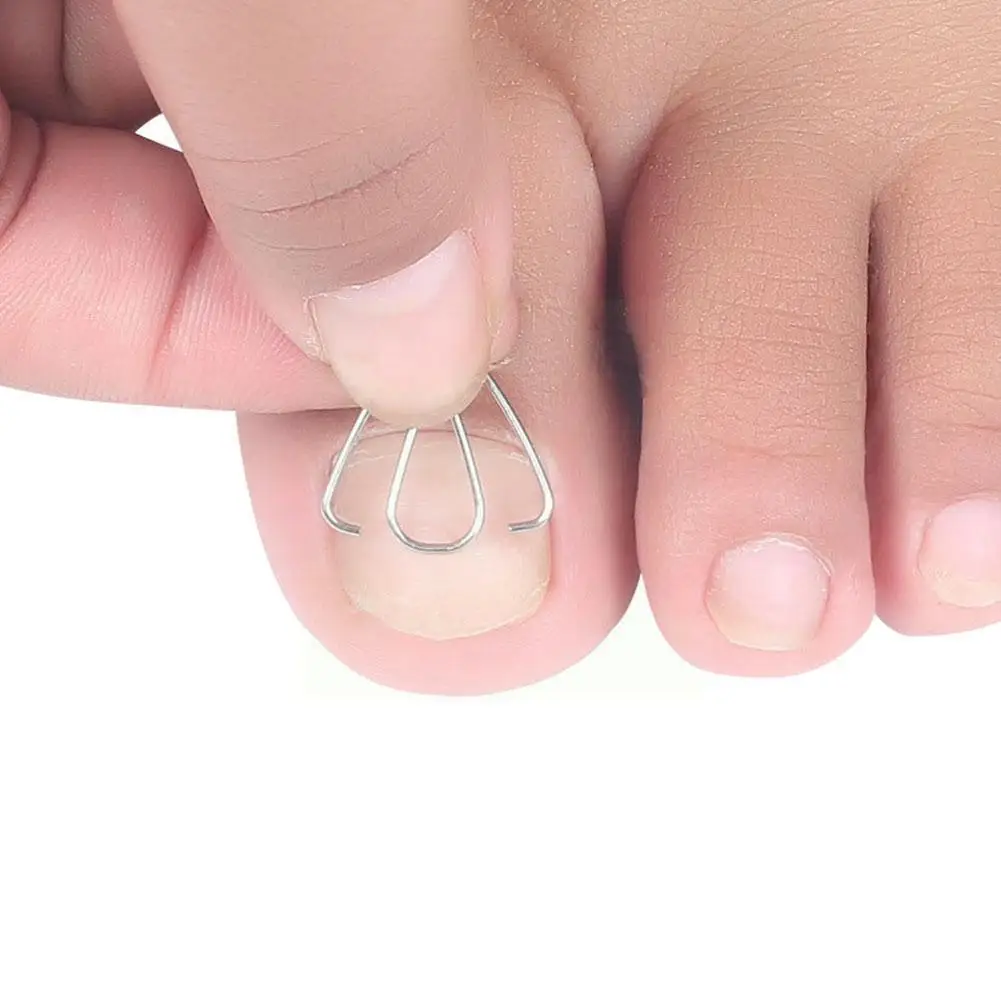 

Professional Toe Nail Recover Ingrown Pedicure Correction Fixer Nail Straightener Toenails Ingrown Correction Care Foot Too C0i6