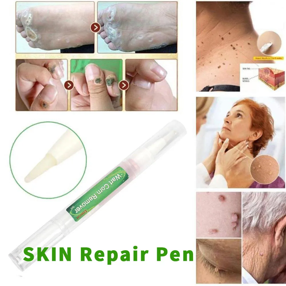 Новинка 3 мл лечение половых органов удаление папилломы бородавок жидкость с